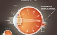 Nhận biết Glaucoma sớm để tránh mù lòa